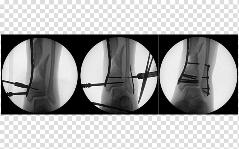 Joint Human leg Metal Metacarpal bones Tibia, the long journey transparent background PNG clipart
