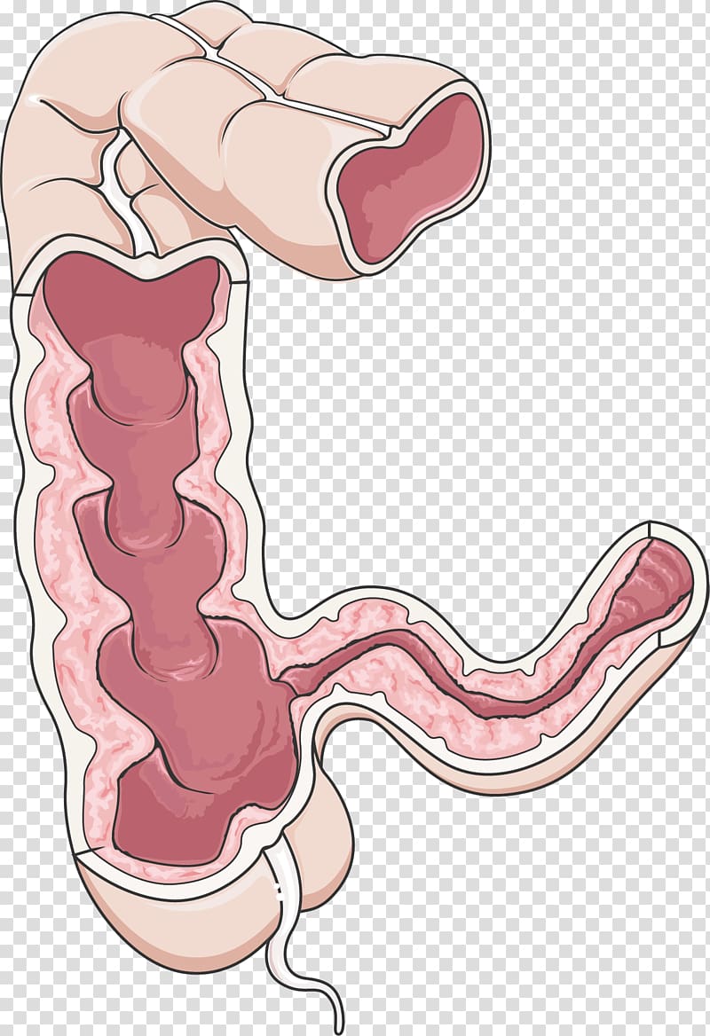 Crohn\'s disease Large intestine Gastrointestinal tract Inflammatory bowel disease, others transparent background PNG clipart