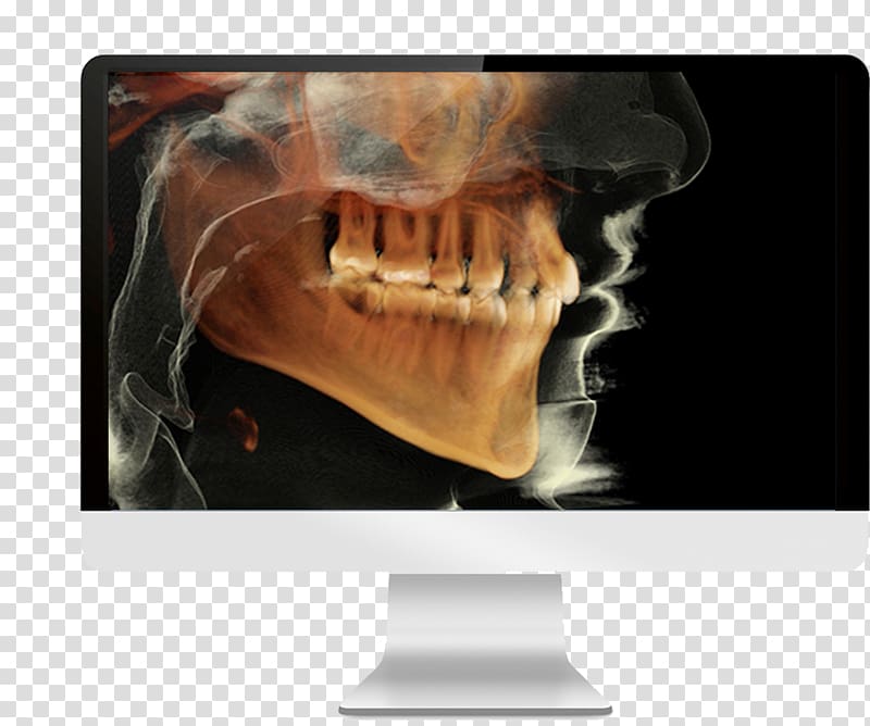 Cone beam computed tomography Dental radiography Dentistry, others transparent background PNG clipart