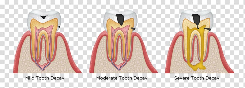 Tooth decay Human tooth Dentistry Dental restoration, dental caries transparent background PNG clipart