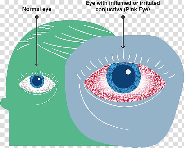 Eye Conjunctivitis Infection Health Medical sign, Centers For Disease Control And Prevention transparent background PNG clipart