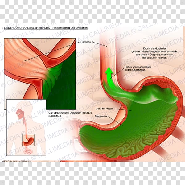 Gastroesophageal reflux disease Gastroenterology Gastroenteritis Pathology, esophagus transparent background PNG clipart
