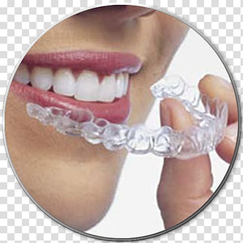 Clear aligners Dental braces Orthodontics Dentistry Therapy, health transparent background PNG clipart