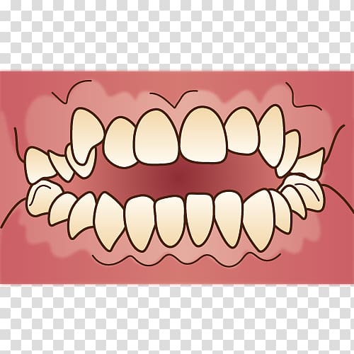 矯正歯科 Dental braces Dentist Therapy Dentition, Dental Braces transparent background PNG clipart
