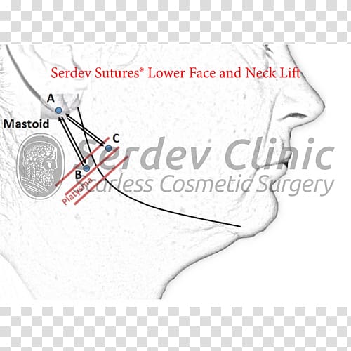 Serdev suture Surgical suture Surgery Rhytidectomy Superficial muscular aponeurotic system, others transparent background PNG clipart