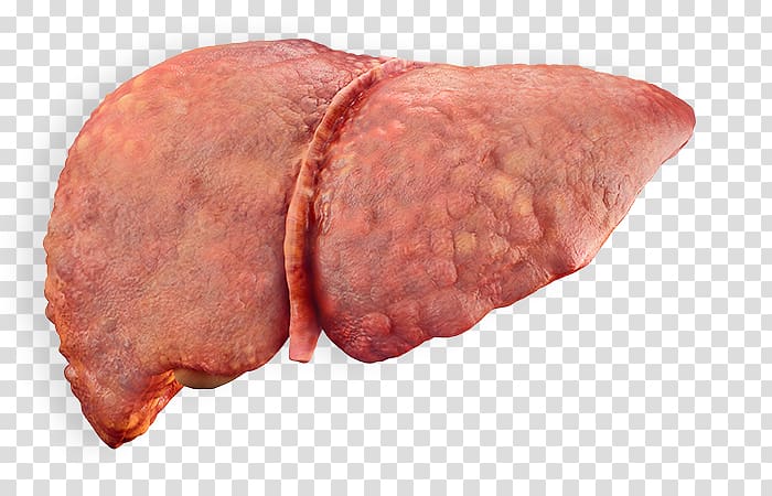 Alcoholic liver disease Cirrhosis Fatty liver, liver transparent background PNG clipart