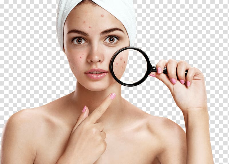 woman with pimple illustration, Skin care Mụn Acne Cleanser, Acne Scars transparent background PNG clipart