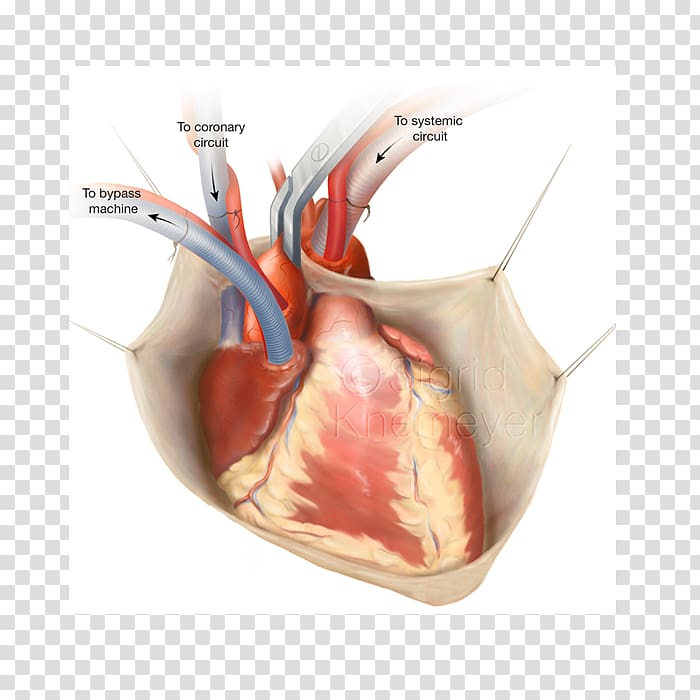 Coronary artery bypass surgery Vascular bypass Off-pump coronary artery bypass Coronary artery disease, heart transparent background PNG clipart