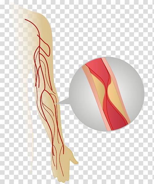 Thrombus Thrombosis Health Care Nursing home care, others transparent background PNG clipart