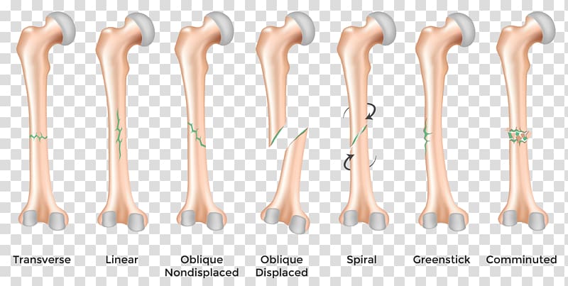 Bone fracture Bone healing Femoral fracture Injury, bones transparent background PNG clipart