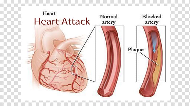 Coronary artery disease Cardiovascular disease Myocardial infarction Cardiology, heart transparent background PNG clipart