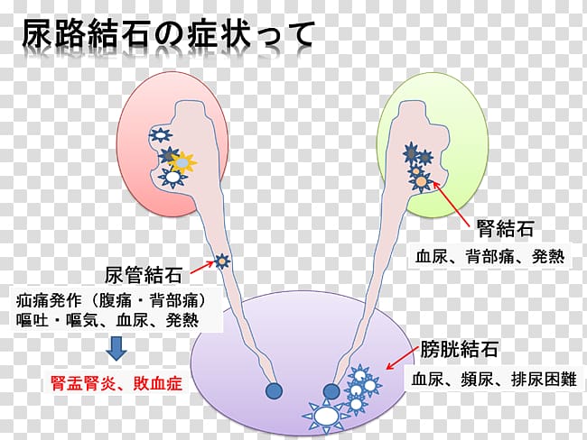 Kidney stone Calculus Excretory system Urology Cancer, Kidney Disease transparent background PNG clipart