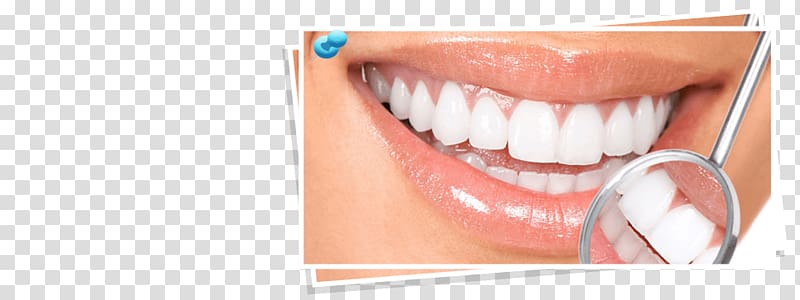 Tooth whitening Human tooth Dentistry Oral hygiene, crown transparent background PNG clipart