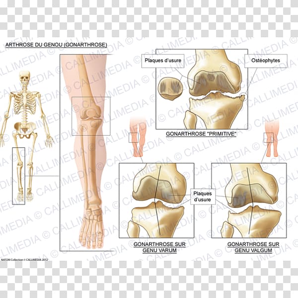 Knee osteoarthritis Knee osteoarthritis Knee arthritis, artrosis de rodilla transparent background PNG clipart