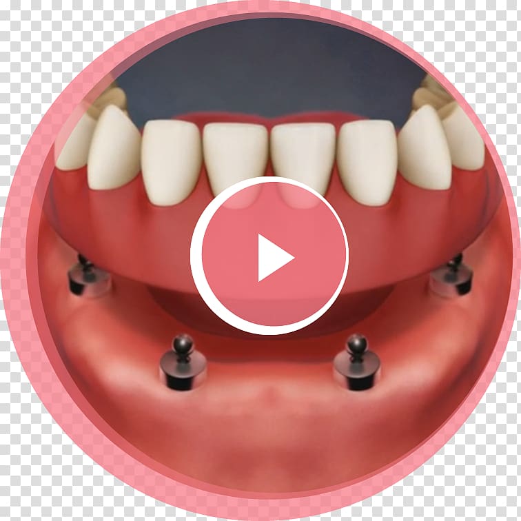 Tooth Dental implant Dentures Removable partial denture, implant dentistry transparent background PNG clipart
