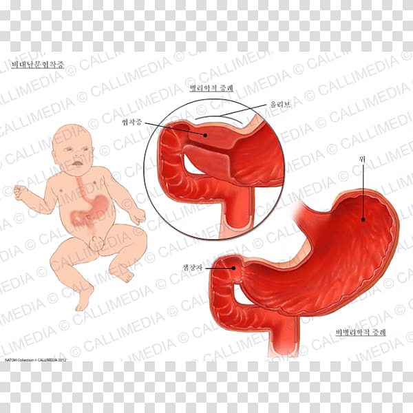 Pyloric stenosis Pylorus Hypertrophy Stomach, others transparent background PNG clipart