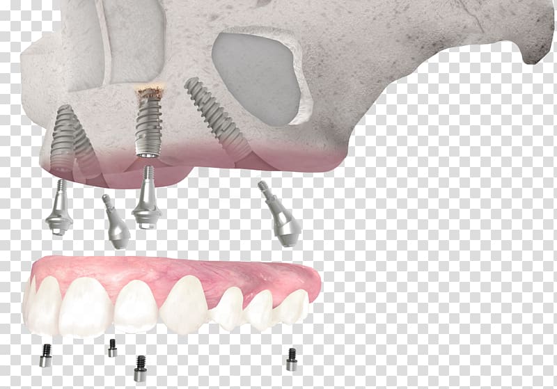 Tooth Dental implant Dentistry All-on-4, Osseointegration transparent background PNG clipart
