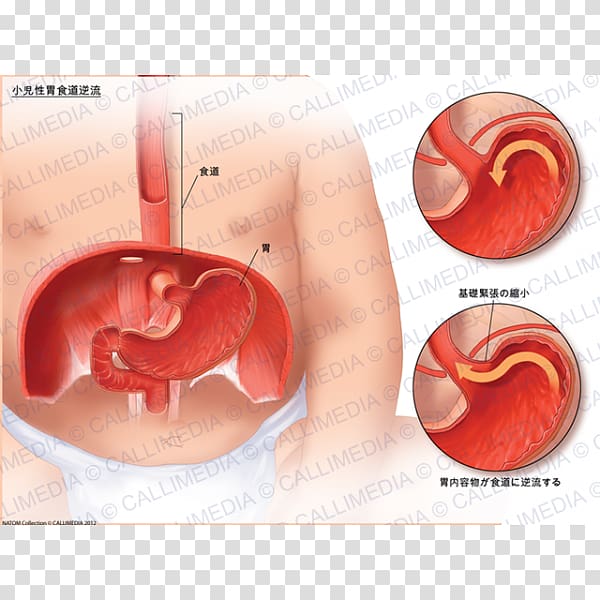 Stomach Gastroesophageal reflux disease Pediatrics Medicine Medscape, esophagus transparent background PNG clipart