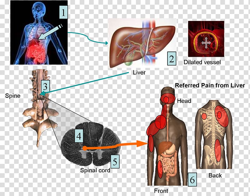 Shoulder pain Neuropathic Pain Peripheral neuropathy Nerve, others transparent background PNG clipart