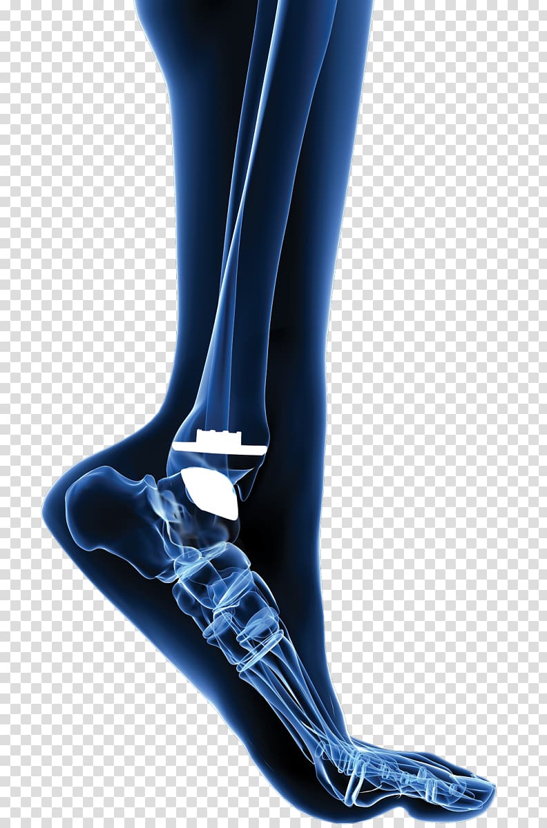Total Ankle Arthroplasty Ankle replacement Joint replacement, joint transparent background PNG clipart