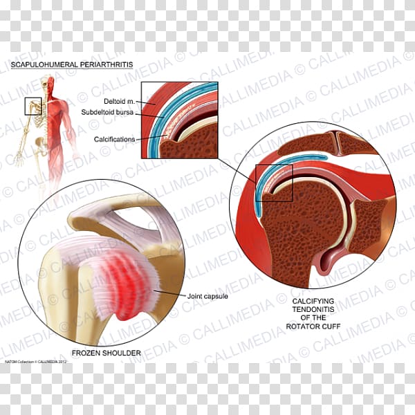 Shoulder Periarthritis Periartrite scapolo-omerale Rheumatology, Endocrine System transparent background PNG clipart