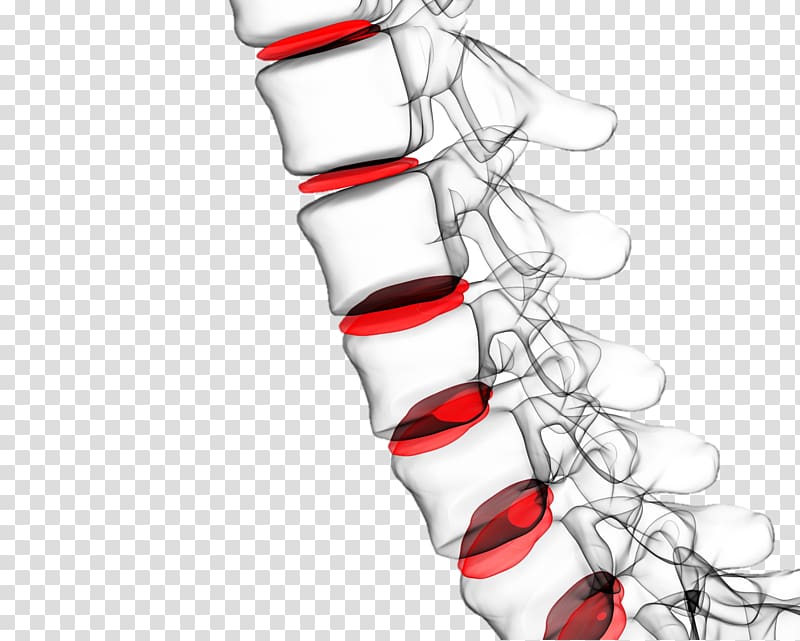 Vertebral column Low back pain Spinal disc herniation Human back, fish vivid vision transparent background PNG clipart