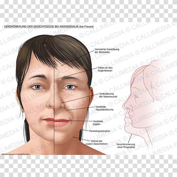 Acromegaly Face Gigantism Growth hormone , Face transparent background PNG clipart