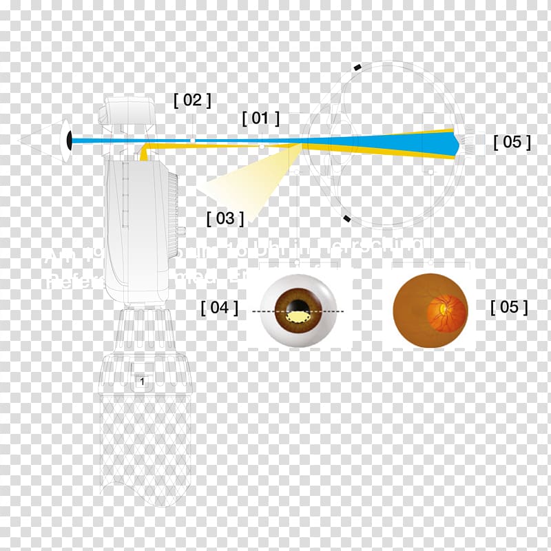 Aspheric lens Brückner-Test Astigmatism Optische Abbildung Refraktion, plus ultra transparent background PNG clipart