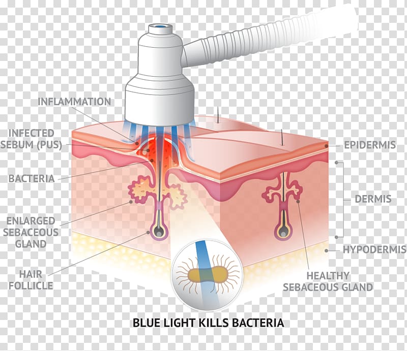 Quasar MD BLUE Light therapy DTLA Derm Skin, light transparent background PNG clipart