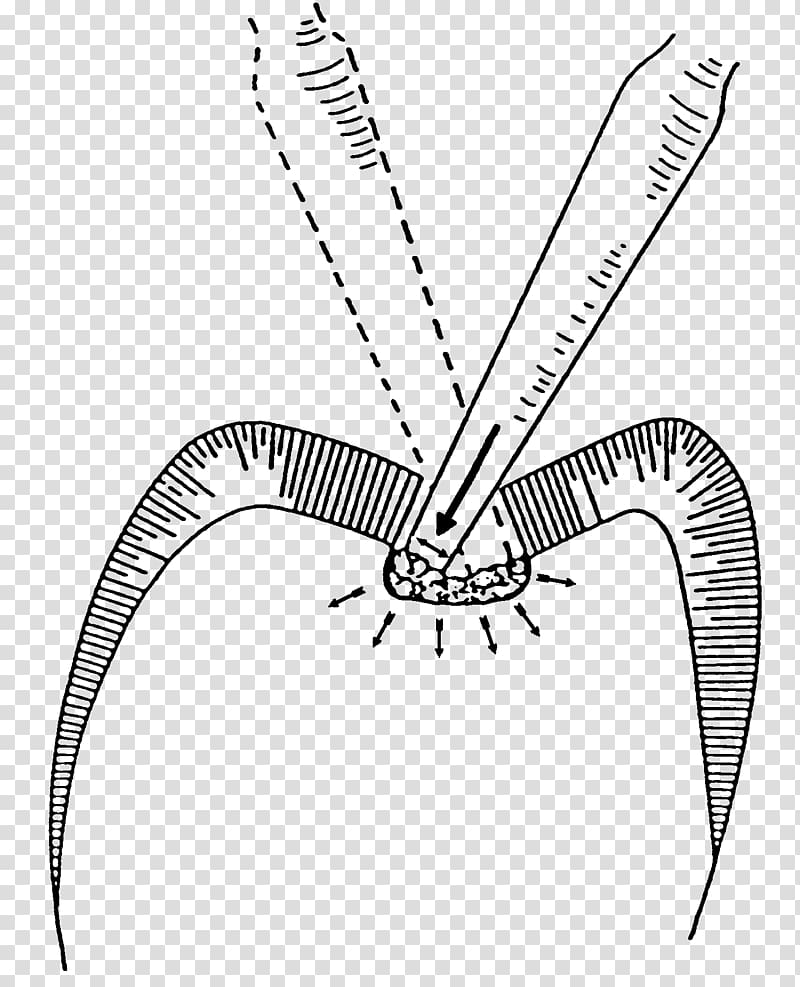 /m/02csf Drawing Line art Invertebrate , effect chart of dental restoration transparent background PNG clipart