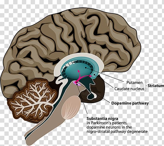 Parkinson's disease Deep brain stimulation Neuroimaging, Brain transparent background PNG clipart
