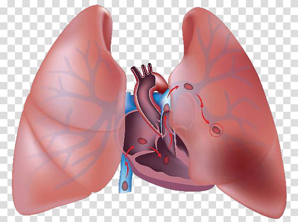 Pulmonary embolism Thrombus Pulmonary artery Embolus Lung, Chronic Obstructive Pulmonary Disease transparent background PNG clipart