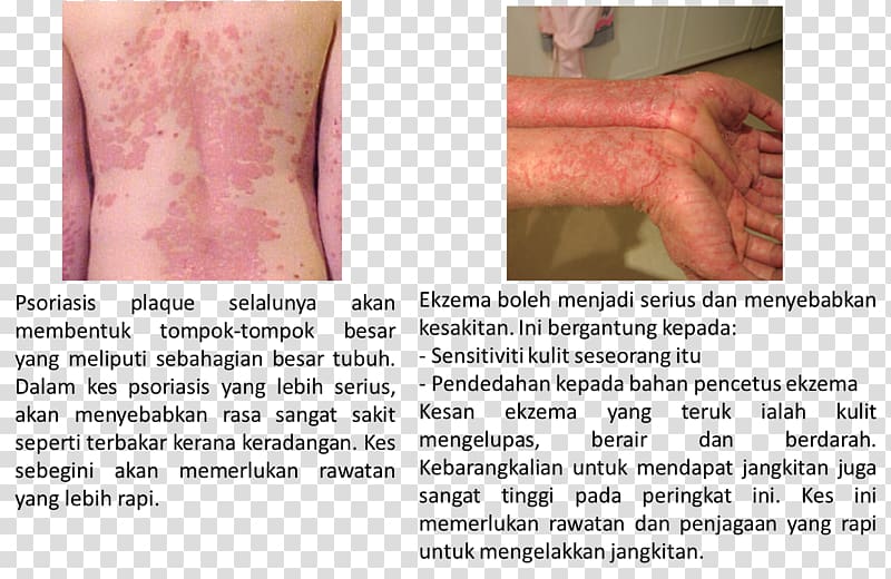 Thumb Cell Psoriasis Skin Eczema, gandum transparent background PNG clipart