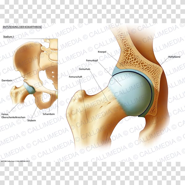 Hip Rheumatoid arthritis Therapy Femur, ráº¯n 3d transparent background PNG clipart