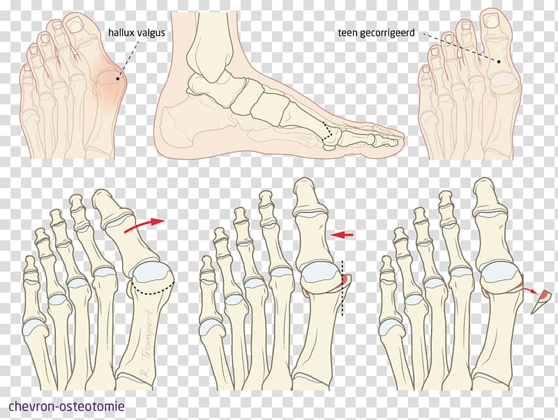 Thumb Hallux Foot Bunion Toe, others transparent background PNG clipart