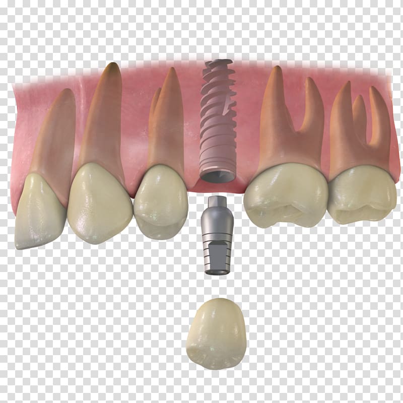 Tooth Dental implant Dentistry Implantology, Dental Implant Cabinet transparent background PNG clipart