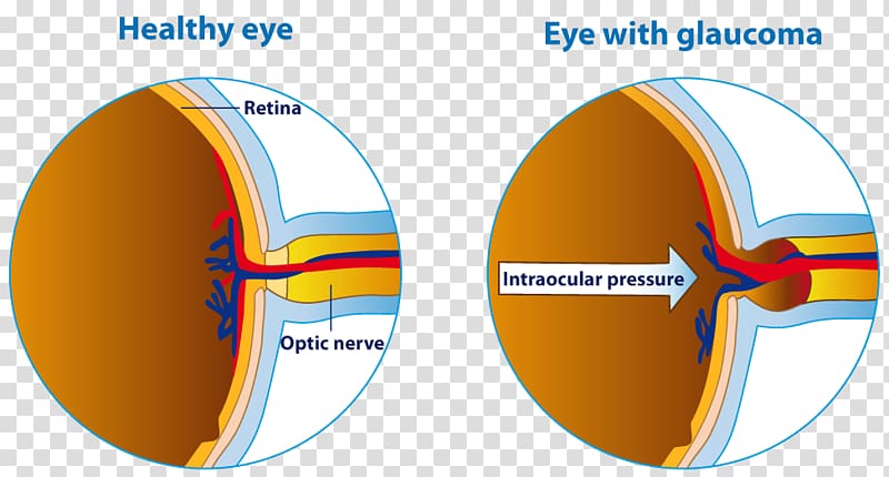 Human eye Glaucoma Eye care professional Optic nerve, Eye transparent background PNG clipart