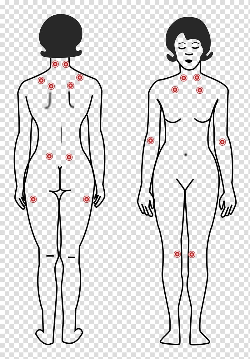 Fibromyalgia Tender point Pain Symptom Myofascial trigger point, back pain transparent background PNG clipart