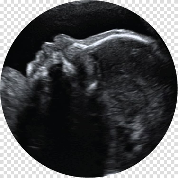 3D ultrasound Ultrasonography Pregnancy Infant, babyultrasound transparent background PNG clipart