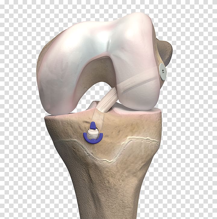 Anterior cruciate ligament reconstruction Bone, ligament transparent background PNG clipart