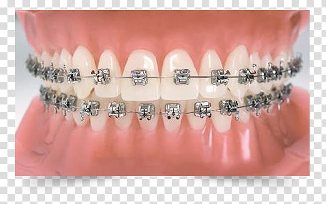 Orthodontics Dental braces Dentistry Tooth, Dental Braces transparent background PNG clipart
