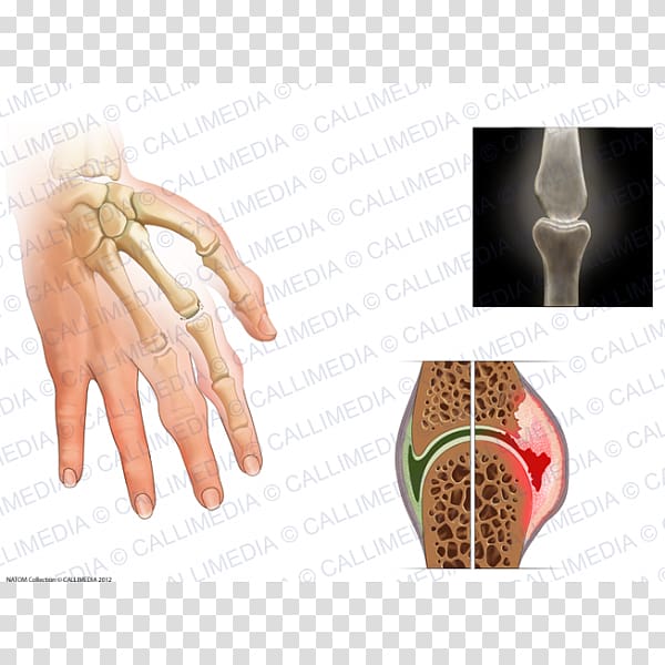 Rheumatoid arthritis Chronic Childhood Arthritis Disease Joint, child transparent background PNG clipart