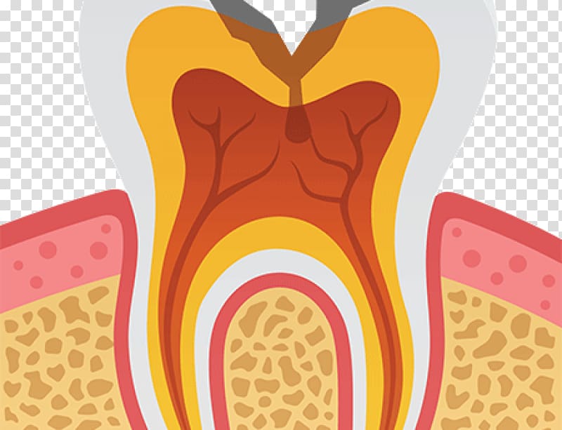 Tooth decay Human tooth Dentistry, Oral Sedation Dentistry transparent background PNG clipart