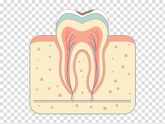 Tooth decay Periodontal disease Bridge Root canal, bridge transparent background PNG clipart