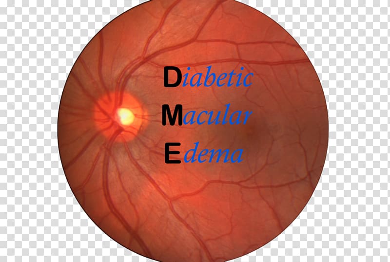 Macular edema Macula of retina Diabetic retinopathy, edema transparent background PNG clipart