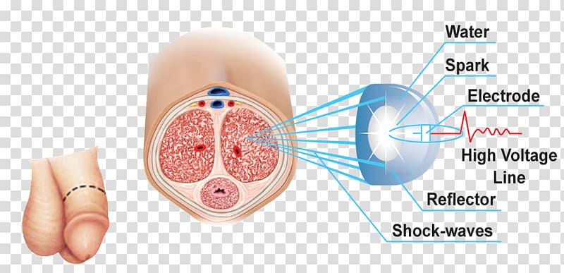Extracorporeal shockwave therapy Erectile dysfunction Shock wave Urology, health transparent background PNG clipart