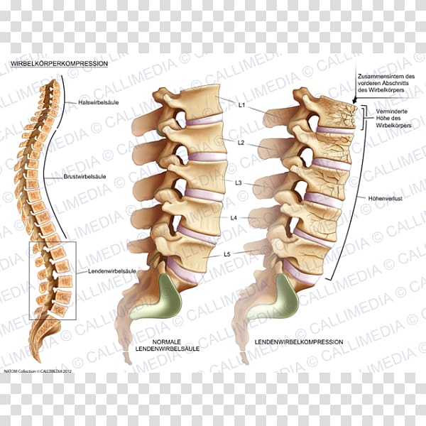 Vertebral compression fracture Vertebral column Lumbar vertebrae Bone fracture, vertebral transparent background PNG clipart