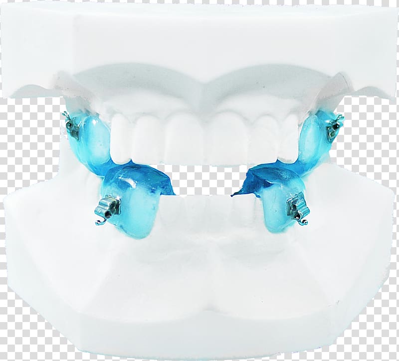 Jaw Orthodontics Dental braces Twin Block Appliance Therapy, rabbit teeth transparent background PNG clipart