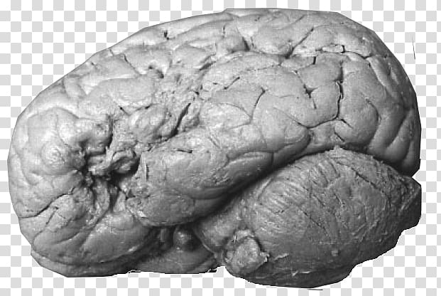 Brain damage Broca\'s area Expressive aphasia, cerebral thrombosis transparent background PNG clipart