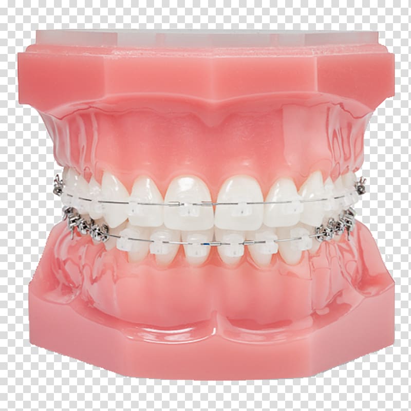 Dental braces Damon system Clear aligners Orthodontics Self-ligating bracket, braces transparent background PNG clipart